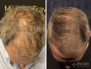 Пересадка волос методом Sapphire FUE до и после
