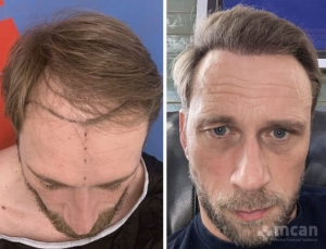 До и после пересадки волос Сапфир в Турции