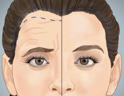 Traditional Brow Lift: 