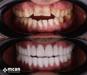 Установка зубных коронок в Турции: до и после