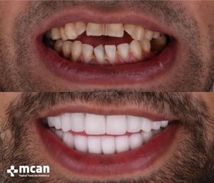 Новая улыбка благодаря зубным коронкам в Турции