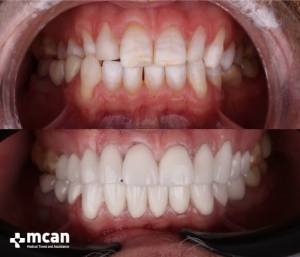 Результат установки зубных коронок в Турции
