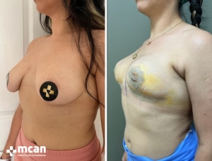 До и после подтяжки груди в Mcan Health 6