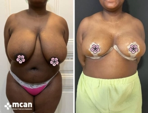 До и после подтяжки груди в Mcan Health в Турции 2