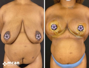 До и после подтяжки груди в Mcan Health в Турции 5