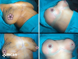 До и после подтяжки груди в Mcan Health в Турции 4