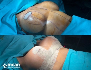 До и после подтяжки груди в Mcan Health в Турции 9