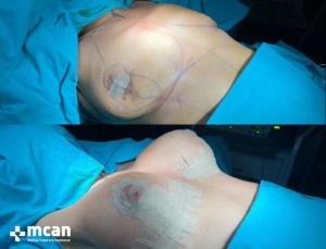 До и после подтяжки груди в Mcan Health 7