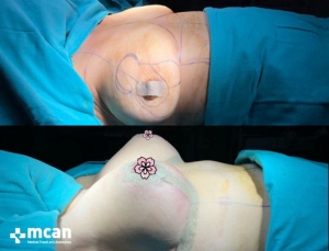 До и после подтяжки груди в Mcan Health 8