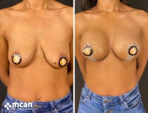 До и после подтяжки груди в Mcan Health в Турции 3
