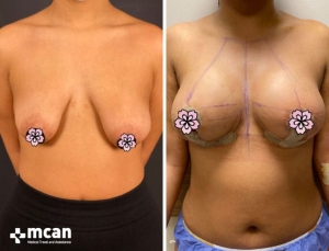 До и после подтяжки груди в Mcan Health в Турции 10