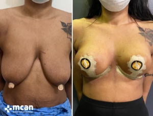 До и после подтяжки груди в Mcan Health в Турции 7
