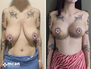 До и после подтяжки груди в Mcan Health 3