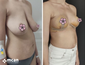 До и после подтяжки груди в Mcan Health 4