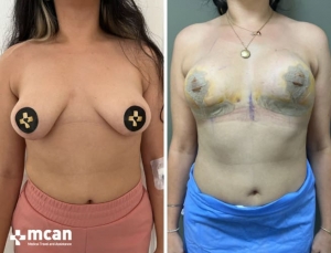 До и после подтяжки груди в Mcan Health 5