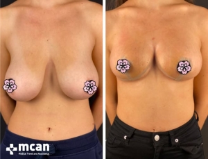 До и после операции по уменьшению груди в Турции 1