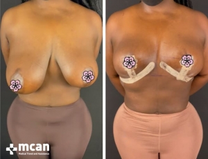 До и после операции по уменьшению груди в Турции 17