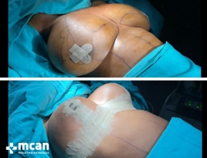 До и после операции по уменьшению груди в Турции 10