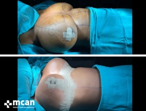 До и после операции по уменьшению груди в Турции 16