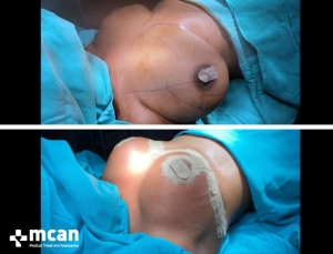 До и после операции по уменьшению груди в Турции 11