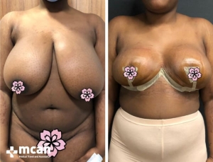 До и после операции по уменьшению груди в Турции 2