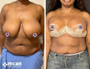 До и после операции по уменьшению груди в Турции 3