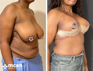 До и после операции по уменьшению груди в Турции 4