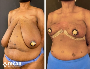 До и после операции по уменьшению груди в Турции 13