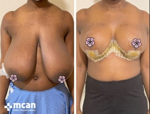До и после операции по уменьшению груди в Турции 6