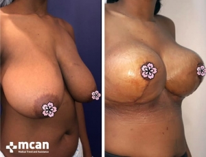 До и после операции по уменьшению груди в Турции 12