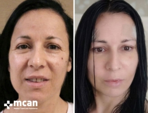 FACELIFT BEFORE AFTER1