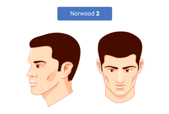 The Stages of Norwood Hamilton Scale 2