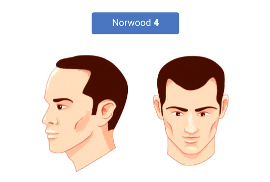 The Stages of Norwood Hamilton Scale 4
