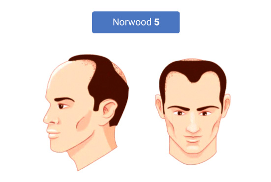 The Stages of Norwood Hamilton Scale 5