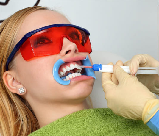 Zahnaufhellung Prozess