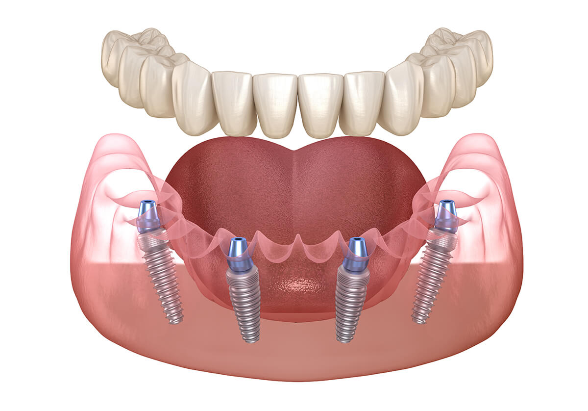 all on four implantes en turquia