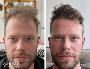 antes y despues fotos de trasplante capilar en turquia 4
