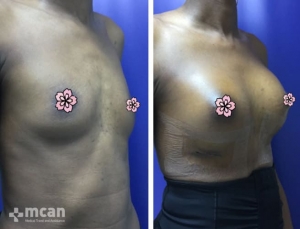 До и после увеличения груди в Турции в Mcan Health 1