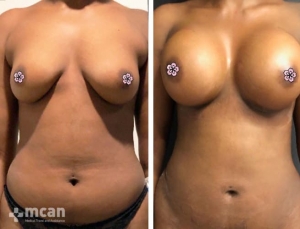 breast enlargement BA12