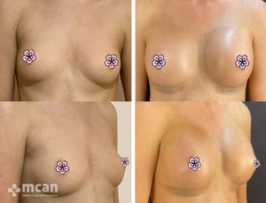 До и после увеличения груди в Турции в Mcan Health 3