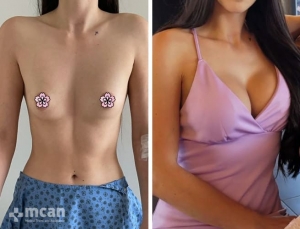 До и после увеличения груди в Турции в Mcan Health