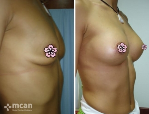 До и после увеличения груди в Турции 2