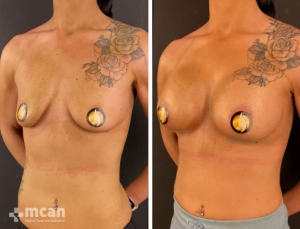 До и после увеличения груди в Турции 1