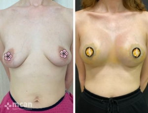До и после увеличения груди в Турции 3