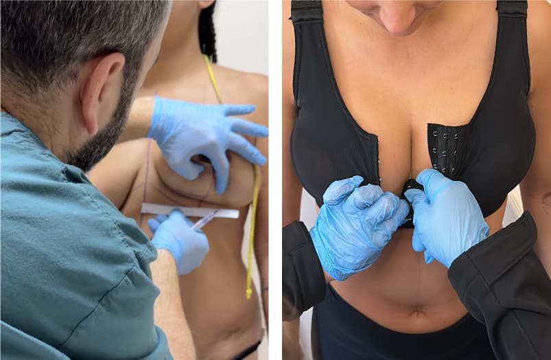Что такое операция по уменьшению груди в Турции»