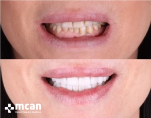 carillas dentales con mcan health 