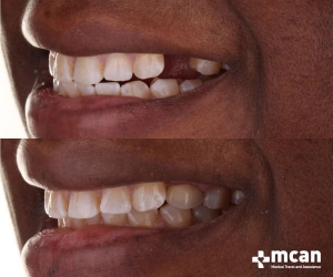 implantes dentales en turquia MCAN Health
