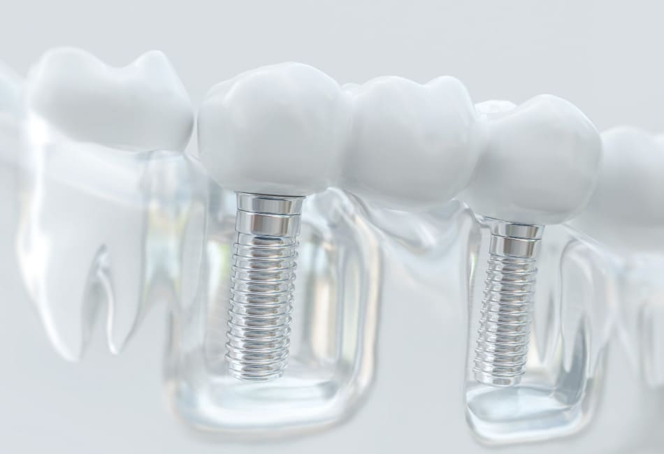 Полное протезирование зубного ряда на имплантах