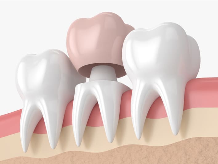 what is dental crown