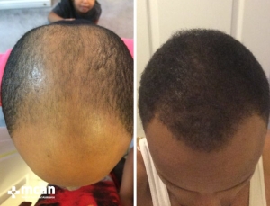afro hair transplant turkey before after photo